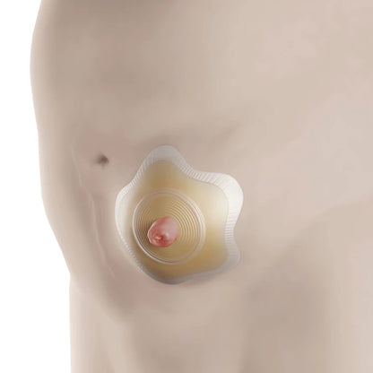 SenSura® Mio Click Convex Flip Ostomy Barrier, 35 mm Stomas, Red Match