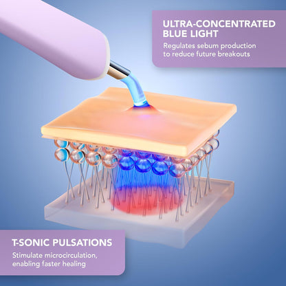 ESPADA™ 2 Plus Acne Therapy Device, Lavender