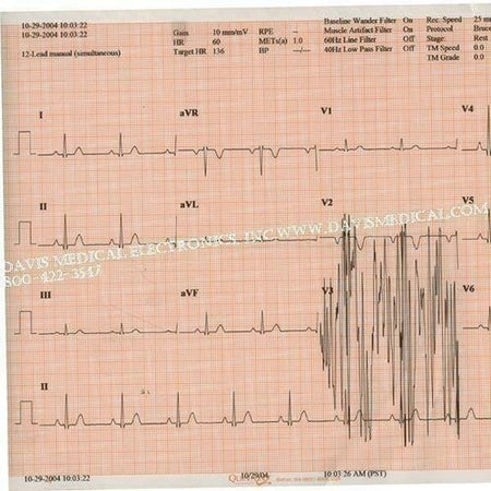 Quinton Diagnostic 18416-002 Medi-Trace Diagnostic Recording Paper, Thermal Paper, Z-Fold, Red Grid
