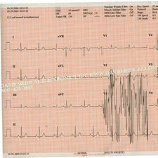 Quinton Medi-Trace Diagnostic Recording Paper, Thermal Paper, Z-Fold, Red Grid, 216mm x 200', 10/Case, 18416-002-imc