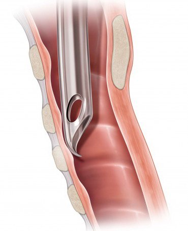 Cuffed Endotracheal Tube Flex-Tip® Curved 7.0 mm Adult Murphy Eye