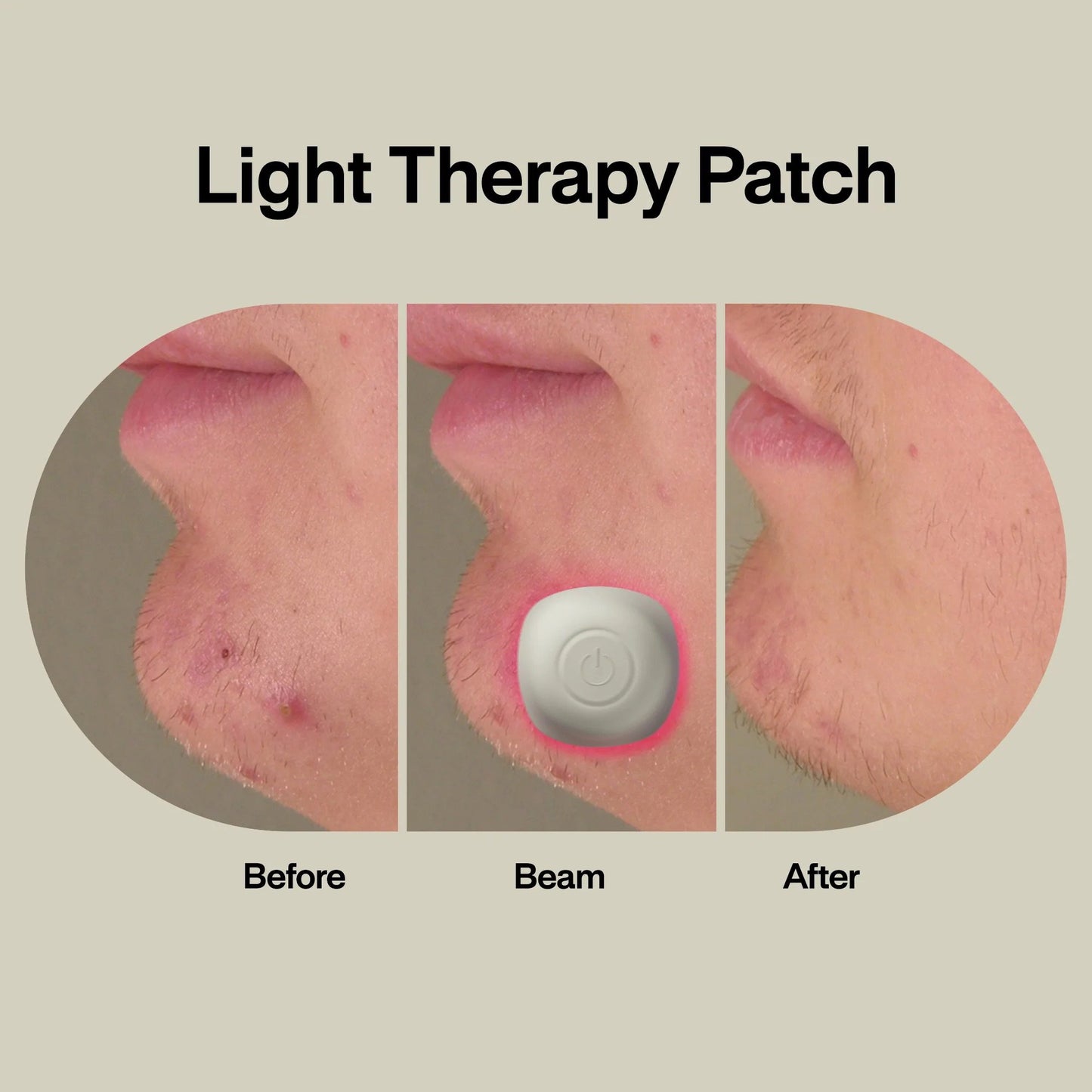 Acne Light Therapy Patch Kit