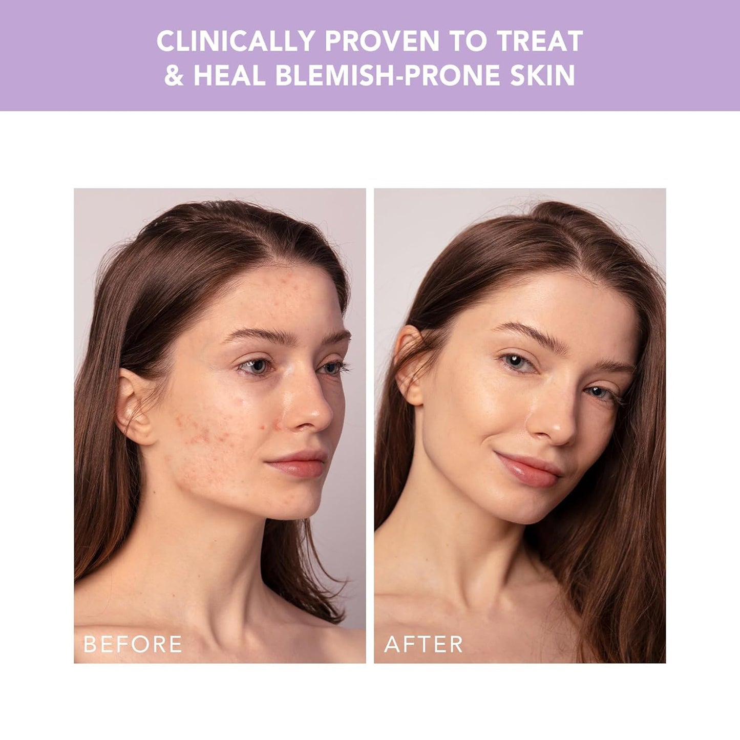 ESPADA™ 2 Plus Acne Therapy Device, Lavender