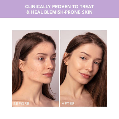 ESPADA™ 2 Plus Acne Therapy Device, Lavender