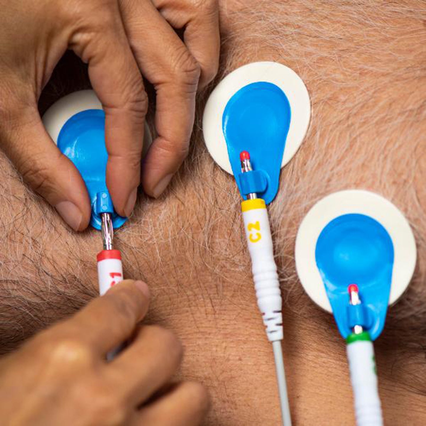 ECG Stress Electrode BlueSensor R Offset Snap Connector Wet Gel Foam Backing Adult Non-Radiolucent 4 per Pack