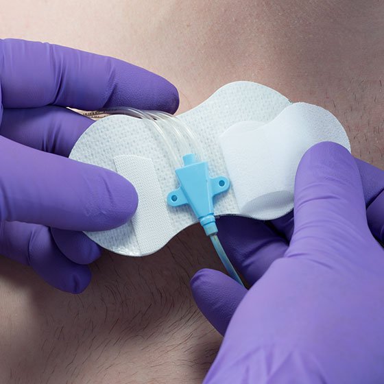 Catheter / Line Securement Device Grip-Lok®
