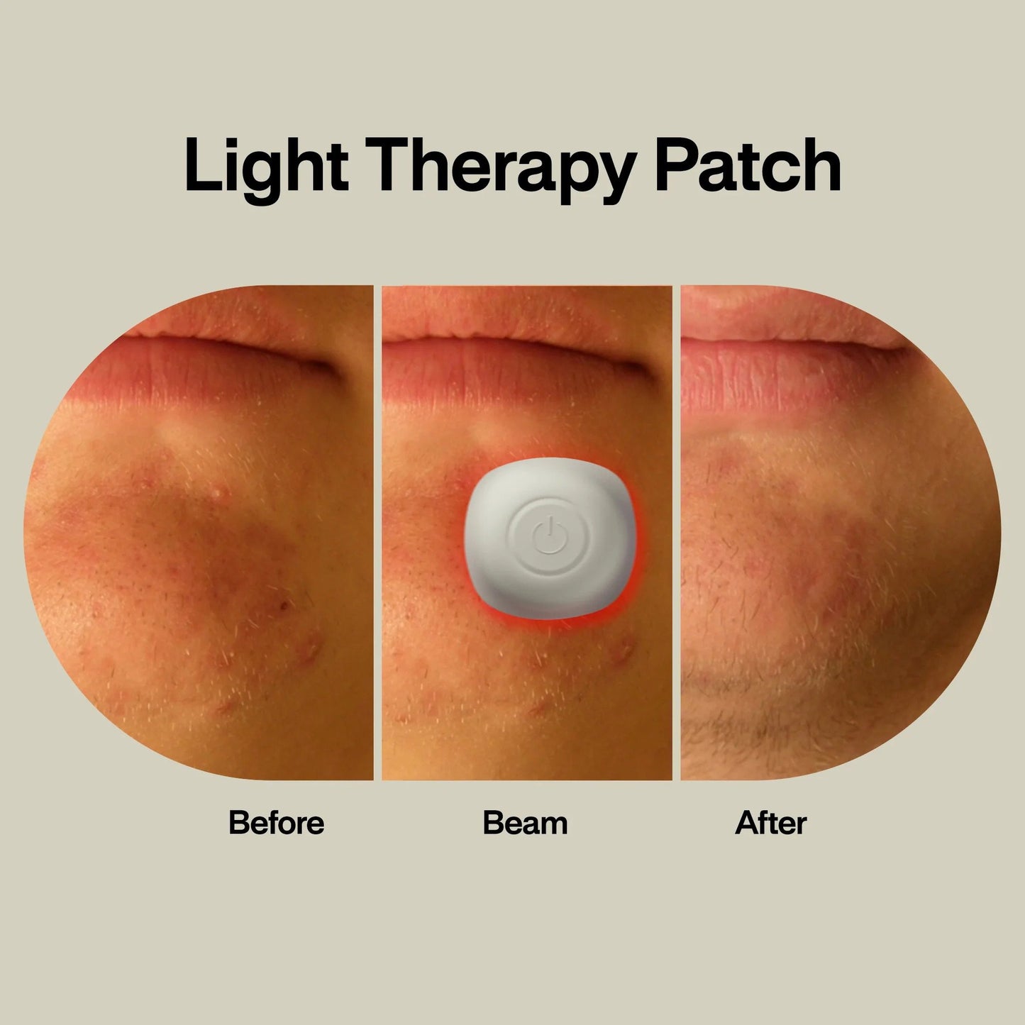 Acne Light Therapy Patch Kit lab