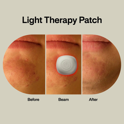 Acne Light Therapy Patch Kit lab