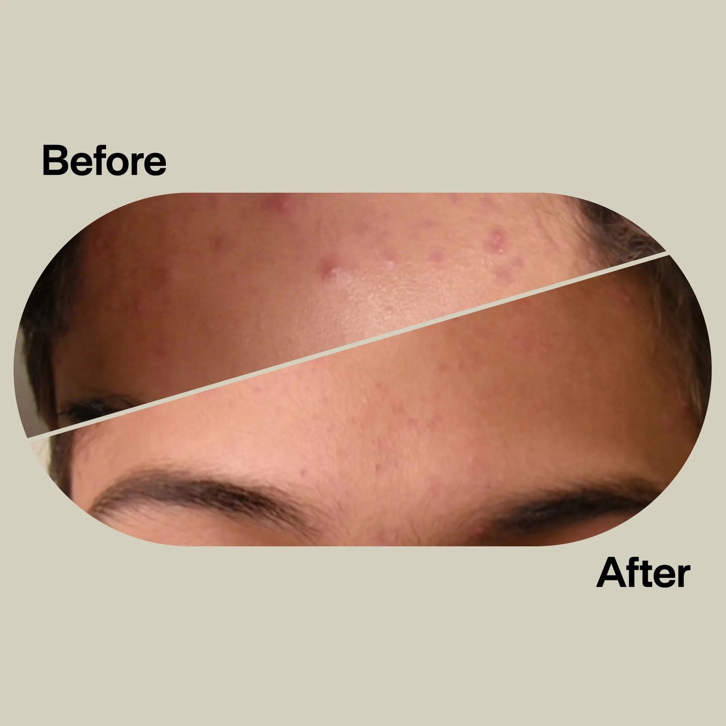 Acne Light Therapy Patch Kit