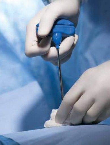 BD BK1000SP Biopsy Tray Safe-T Plus Bone Marrow Without Needle