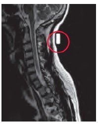 Radiology Skin Marker MRI Spee-D-Mark™
