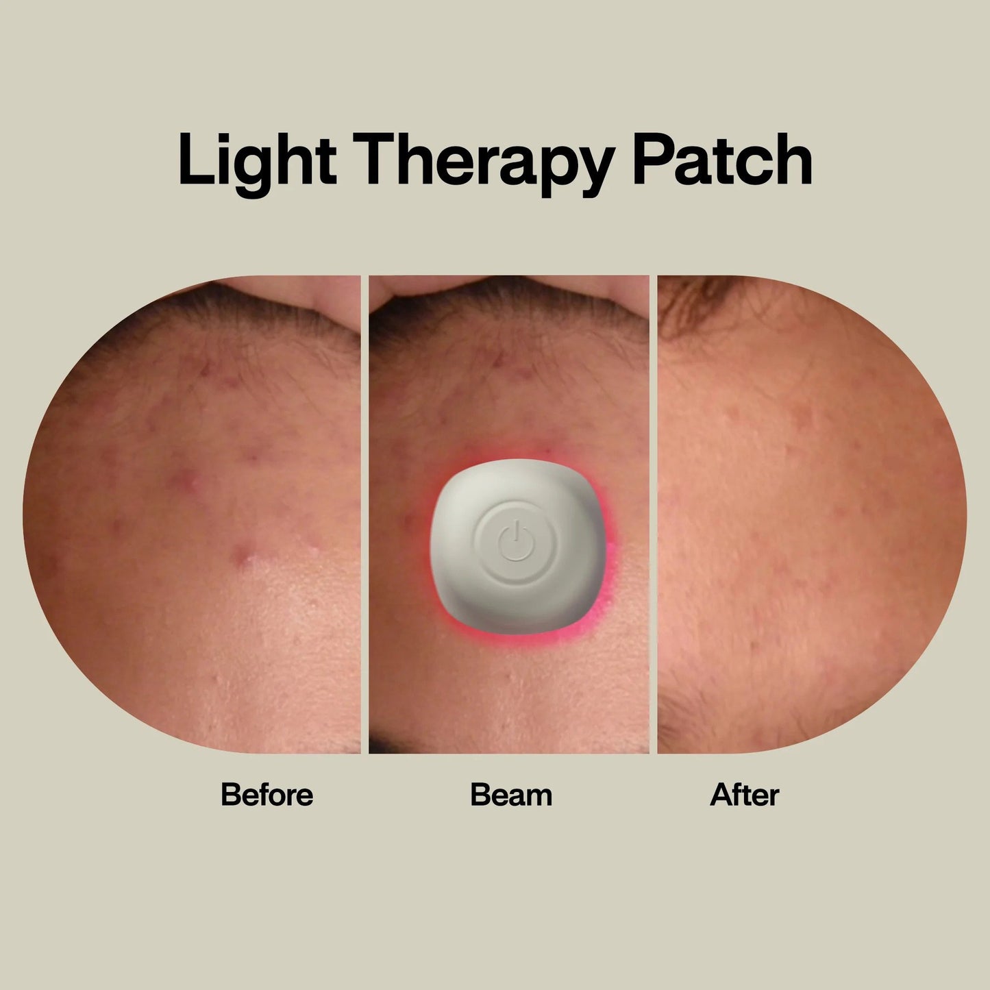 Acne Light Therapy Patch Kit lab